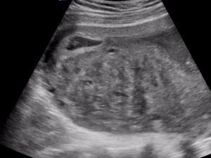 uterus fibroids ultrasound