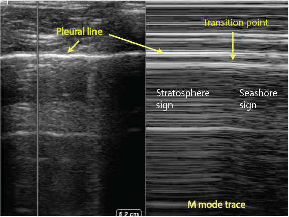 Picture Of Pneumothorax M Mode Ultrasound