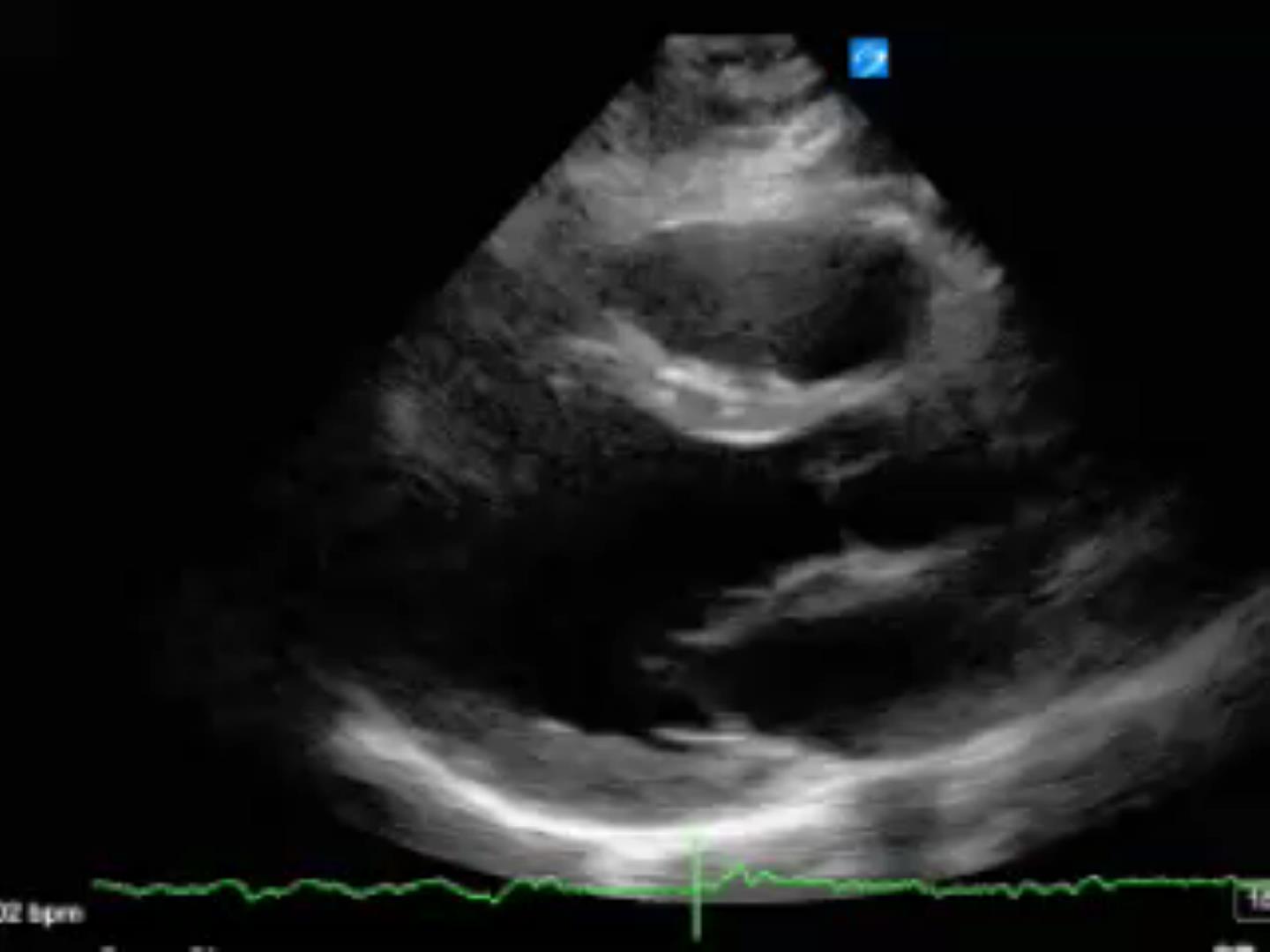 Bicuspid Aortic valve Critical Care Sonography