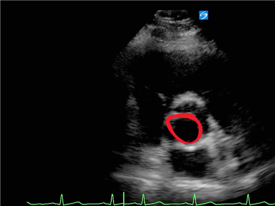 Bicuspid Aortic valve Critical Care Sonography
