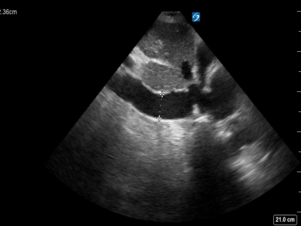 Pericardial effusion with fibrinous strands Critical Care Sonography