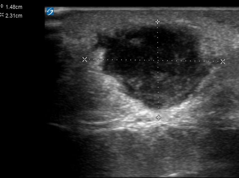 Infected breast sebaceous cyst Critical Care Sonography