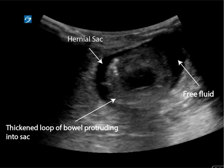 Incarcerated umbilical hernia Critical Care Sonography