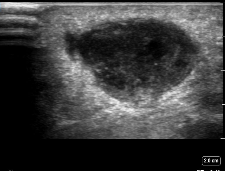 Infected breast sebaceous cyst Critical Care Sonography
