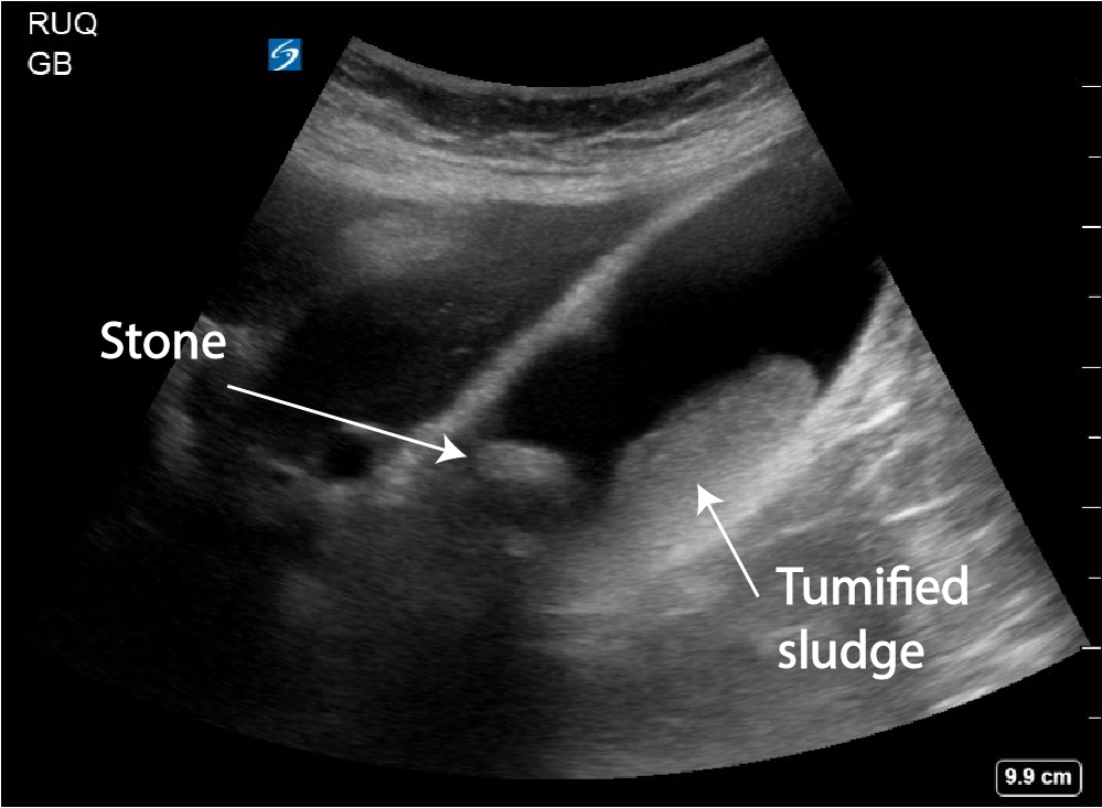 Gallstone Tumification Of Sludge Critical Care Sonography gallstone-tumification-of-sludge-critical-care-sonography