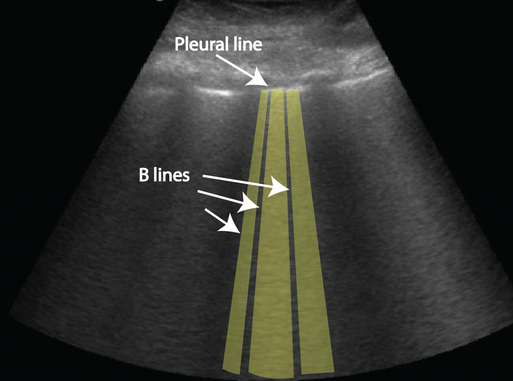 Pulmonary oedema - Critical Care Sonography