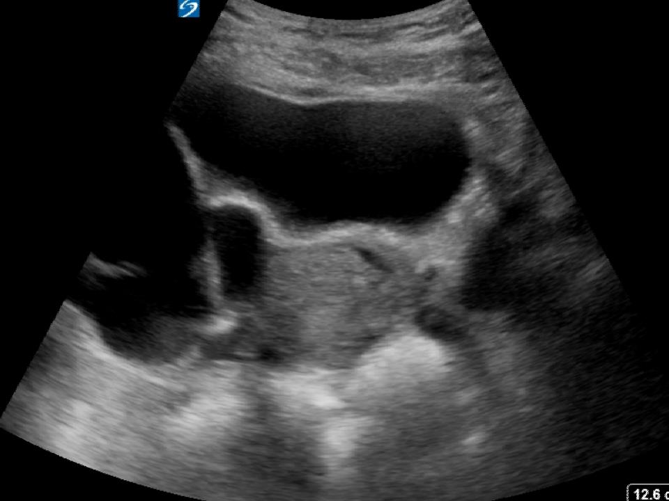 Appendicitis , right ovarian cyst Critical Care Sonography