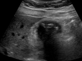 Wall Echo Shadow - Critical Care Sonography