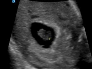 Early Pregnancy Fetal Heart Beat Now You See It Now You Don T Critical Care Sonography