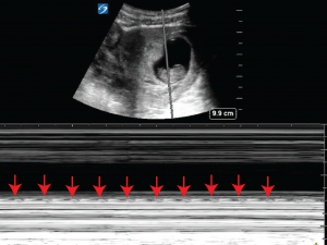 Early Pregnancy Fetal Heart Beat Now You See It Now You Don T Critical Care Sonography