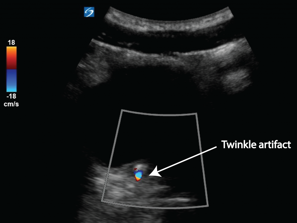 Renal colic - the twinkle artifact - Critical Care Sonography