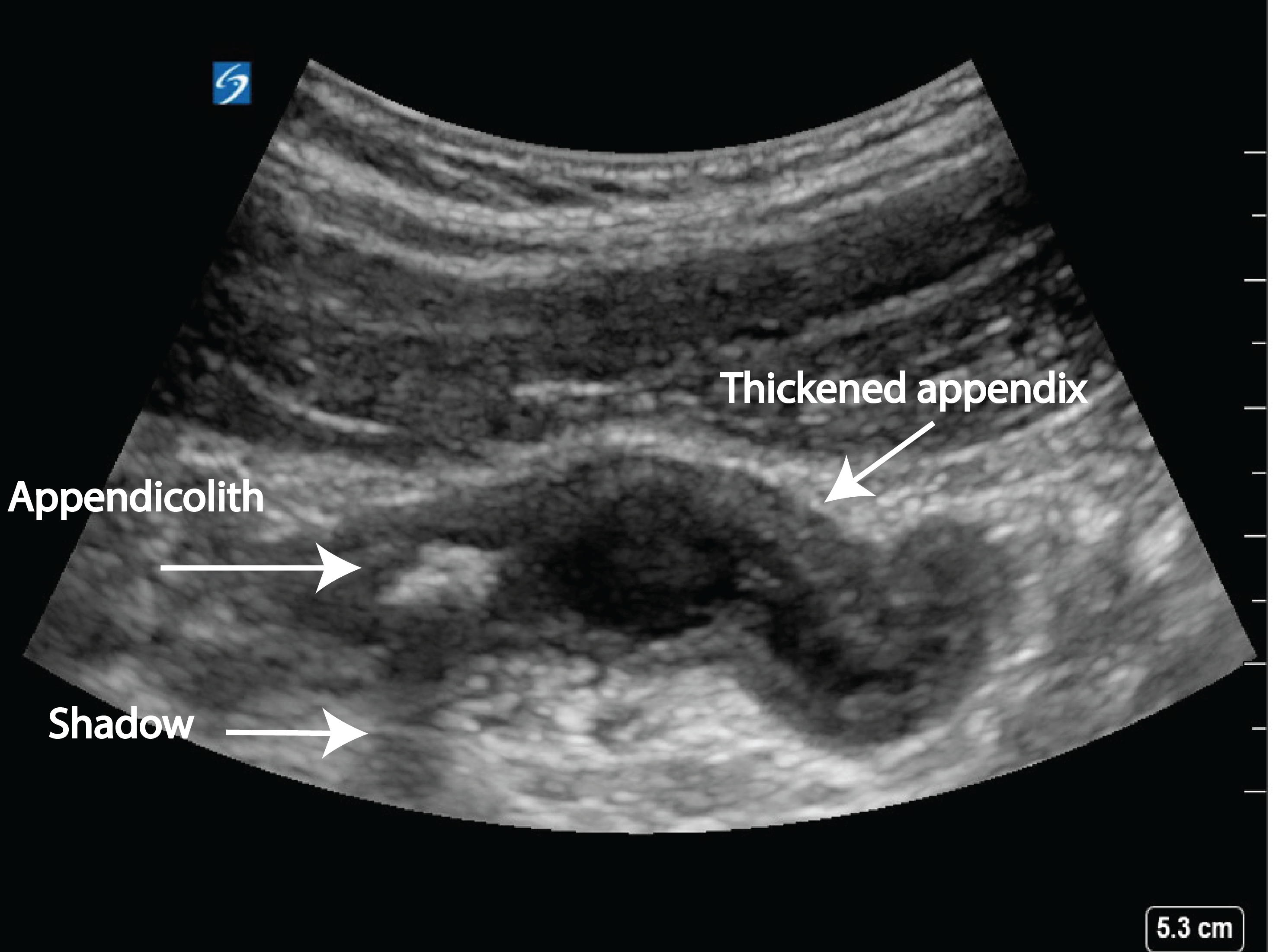 Appendicitis - Critical Care Sonography