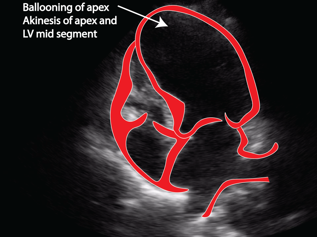 Takotsubo cardiomyopathy Critical Care Sonography