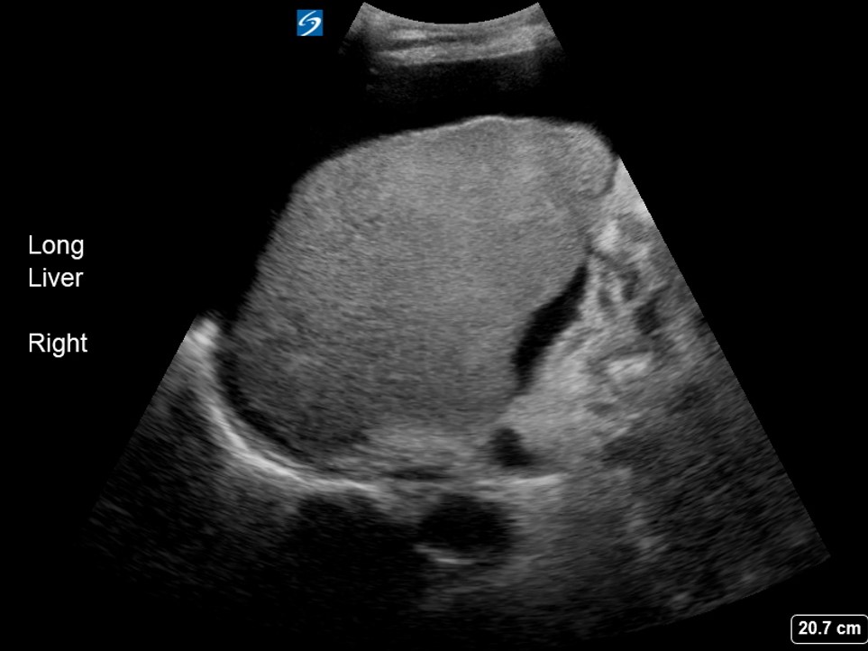Alcoholic cirrhosis Critical Care Sonography