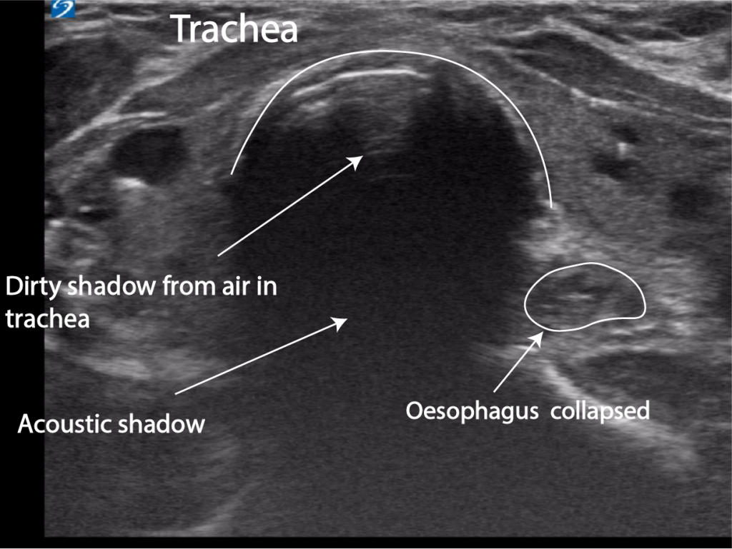 Oesophageal intubation Double tract sign Critical Care Sonography