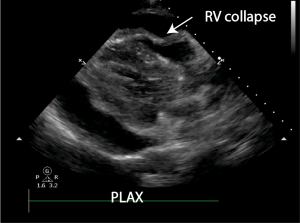 cardiac tamponade echo