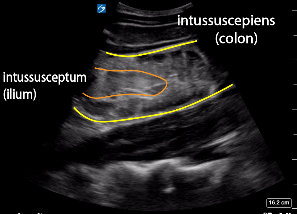 22. Case of the month: Intussusception in a 6 year old - Critical Care ...