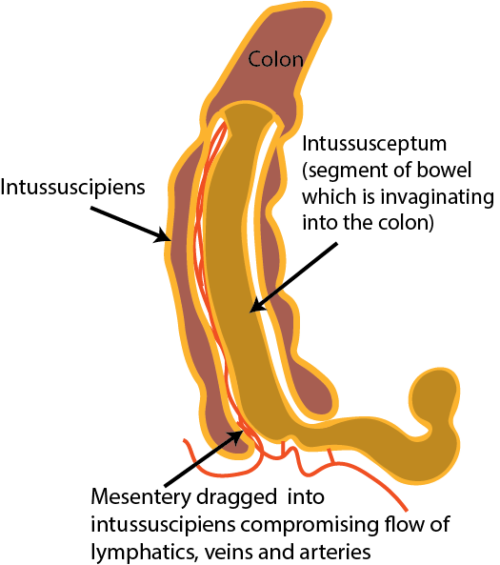 22. Case of the month: Intussusception in a 6 year old - Critical Care ...