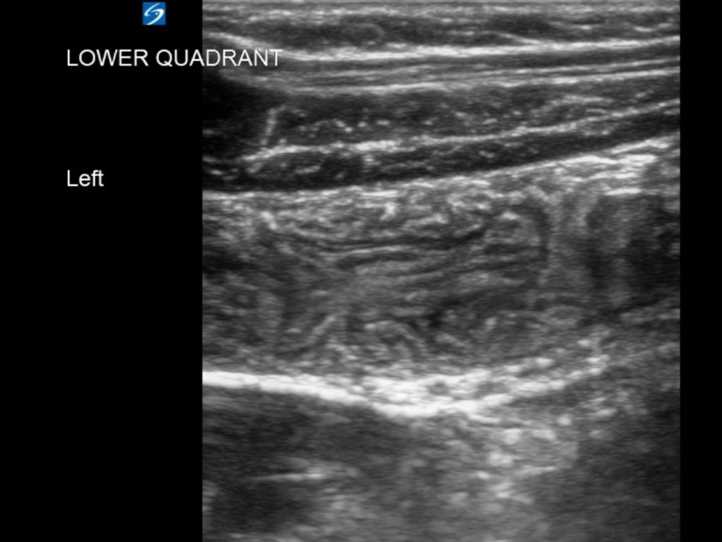Intussusception in a 6 year old Critical Care Sonography