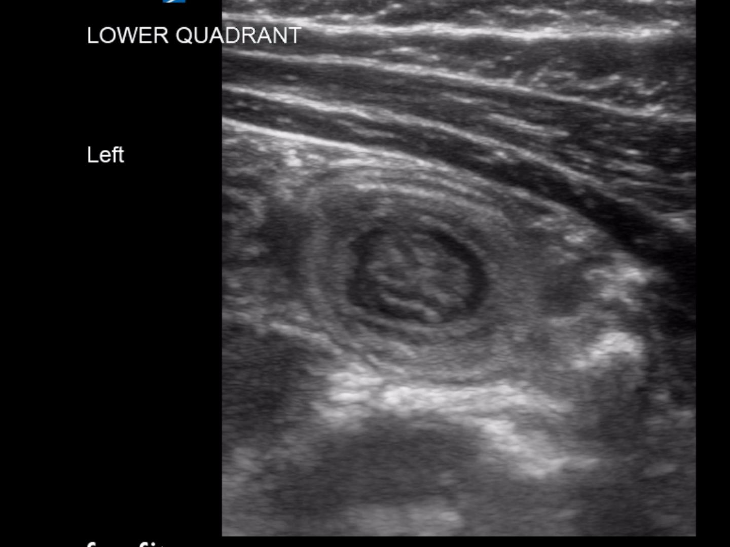Intussusception in a 6 year old Critical Care Sonography