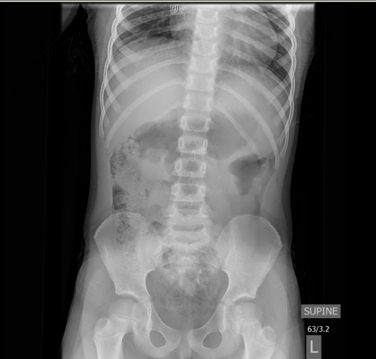 Intussusception in a 6 year old Critical Care Sonography