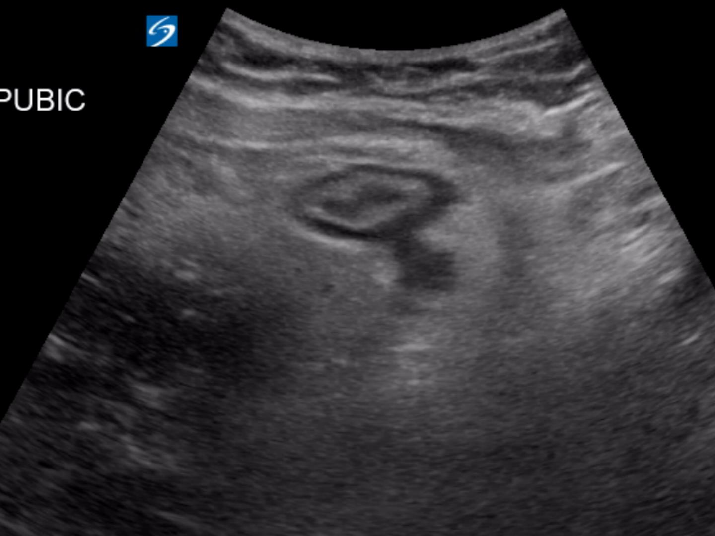 Diverticulitis Critical Care Sonography