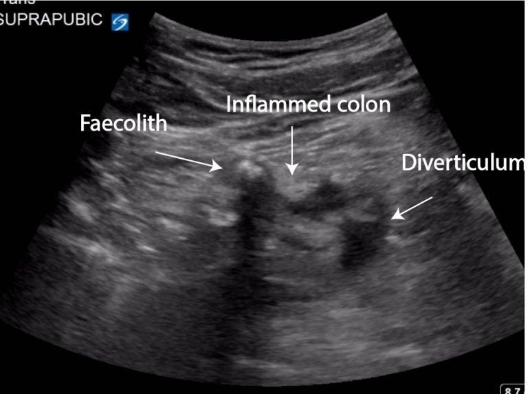 Diverticulitis Critical Care Sonography