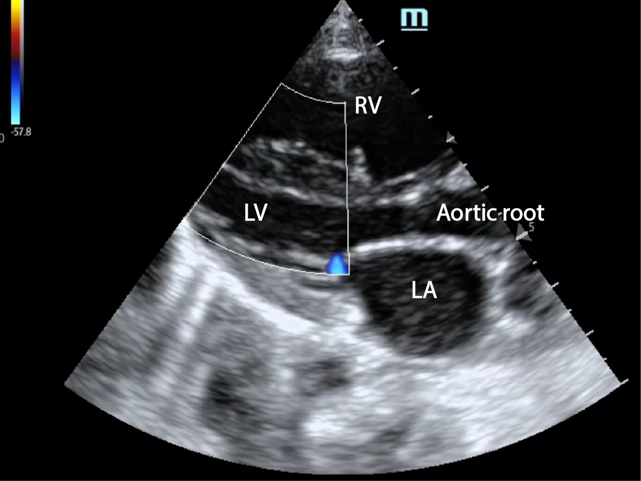 Coarctation of the aorta in a neonate Critical Care Sonography