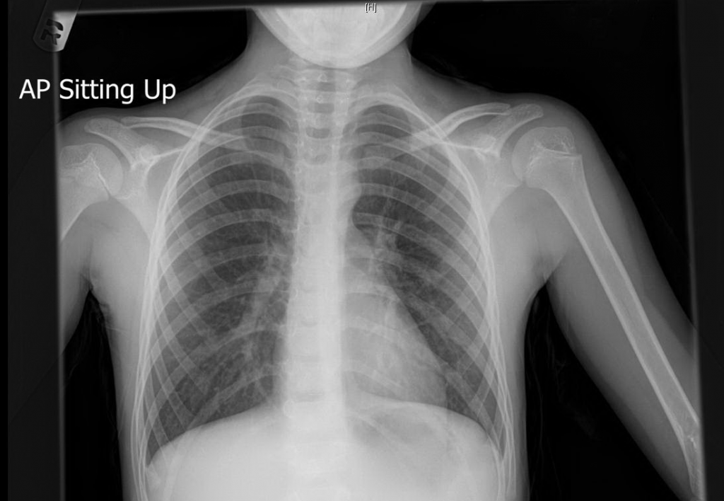 Pulmonary hypertension in a child Critical Care Sonography