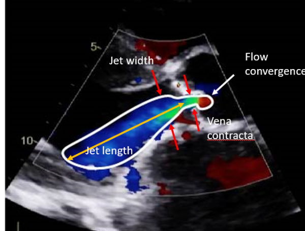 Assessment Of Aortic Regurgitation Critical Care Sonography aortic-regurgitation-what-is-it-causes-osmosis