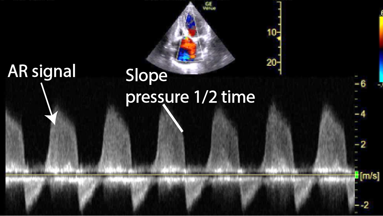 Assessment of aortic regurgitation Critical Care Sonography
