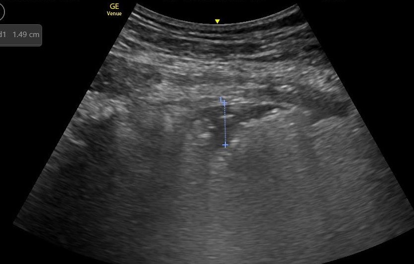 Lung Ultrasound findings in COVID 19 - Critical Care Sonography