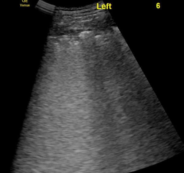 Lung Ultrasound findings in COVID 19 - Critical Care Sonography
