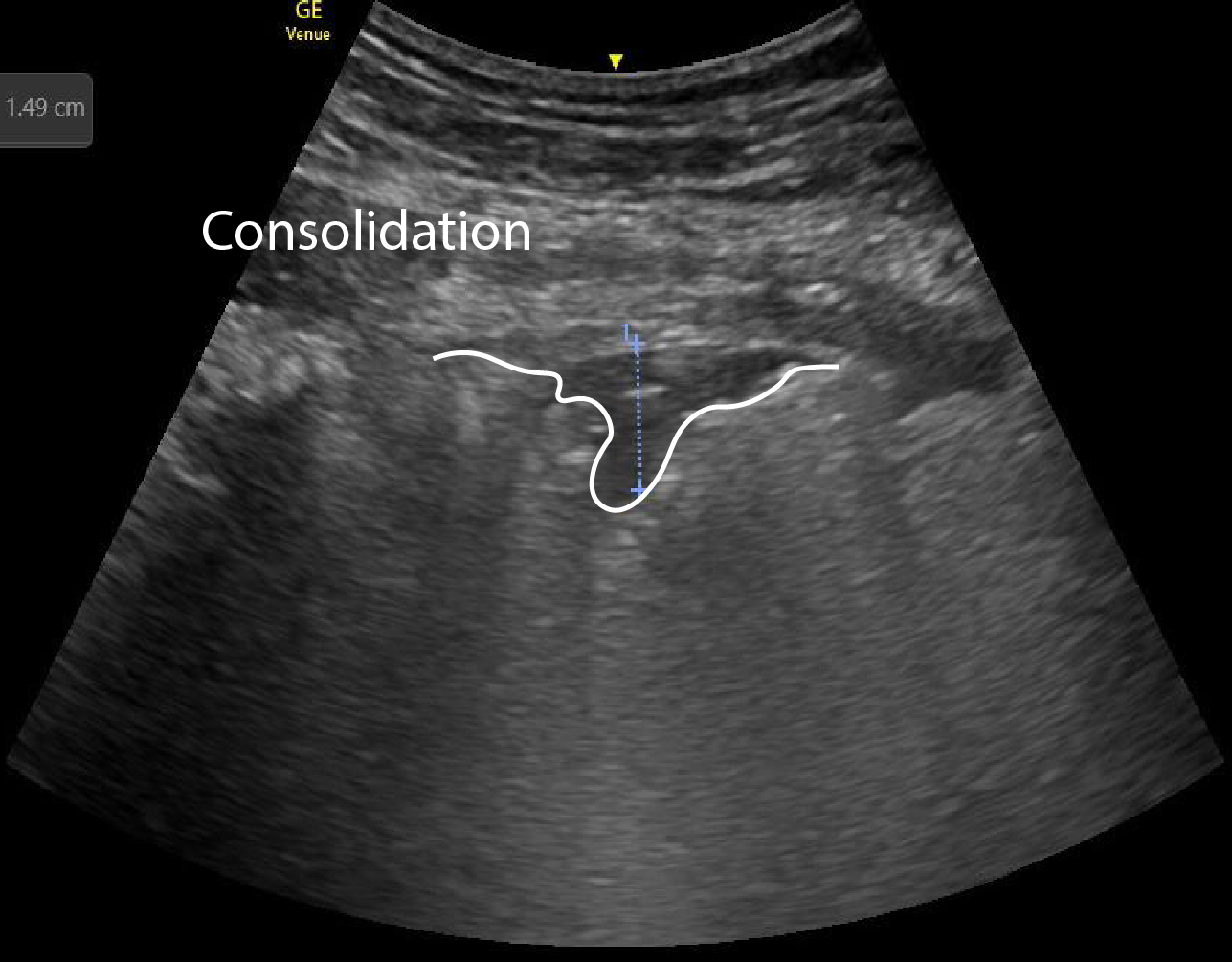 Lung Ultrasound findings in COVID 19 - Critical Care Sonography
