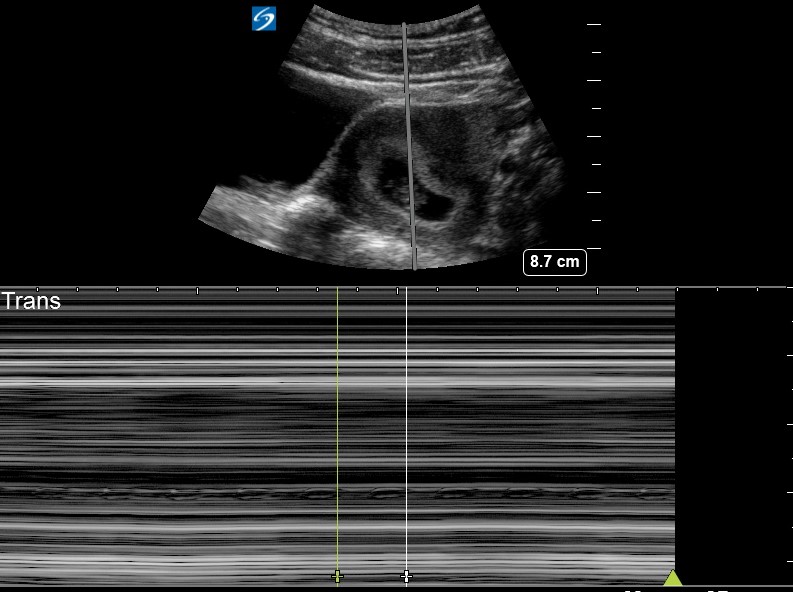 1st trimester Quiz Critical Care Sonography