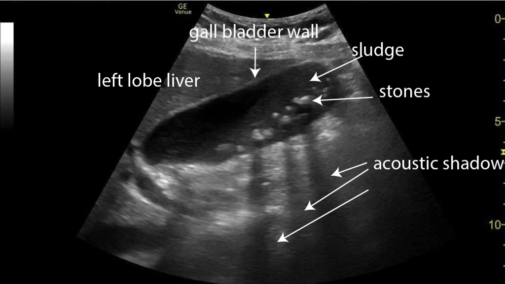 3 Case Of The Month Gallstones Dilated CBD Critical Care Sonography