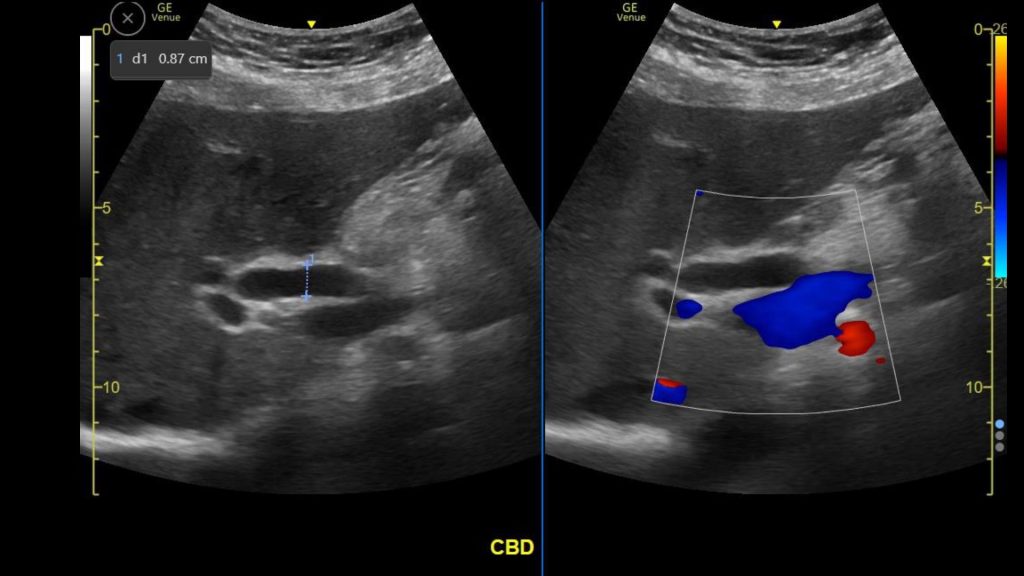 3 Case Of The Month Gallstones Dilated CBD Critical Care Sonography